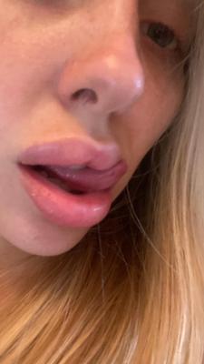 Josie loves lip filler and selling on Snap