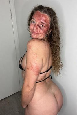 Birthmarks and Burn Scars